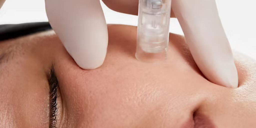 skin boosters and mesotherapy application on face